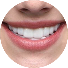 Fair skin veneer user smiling
