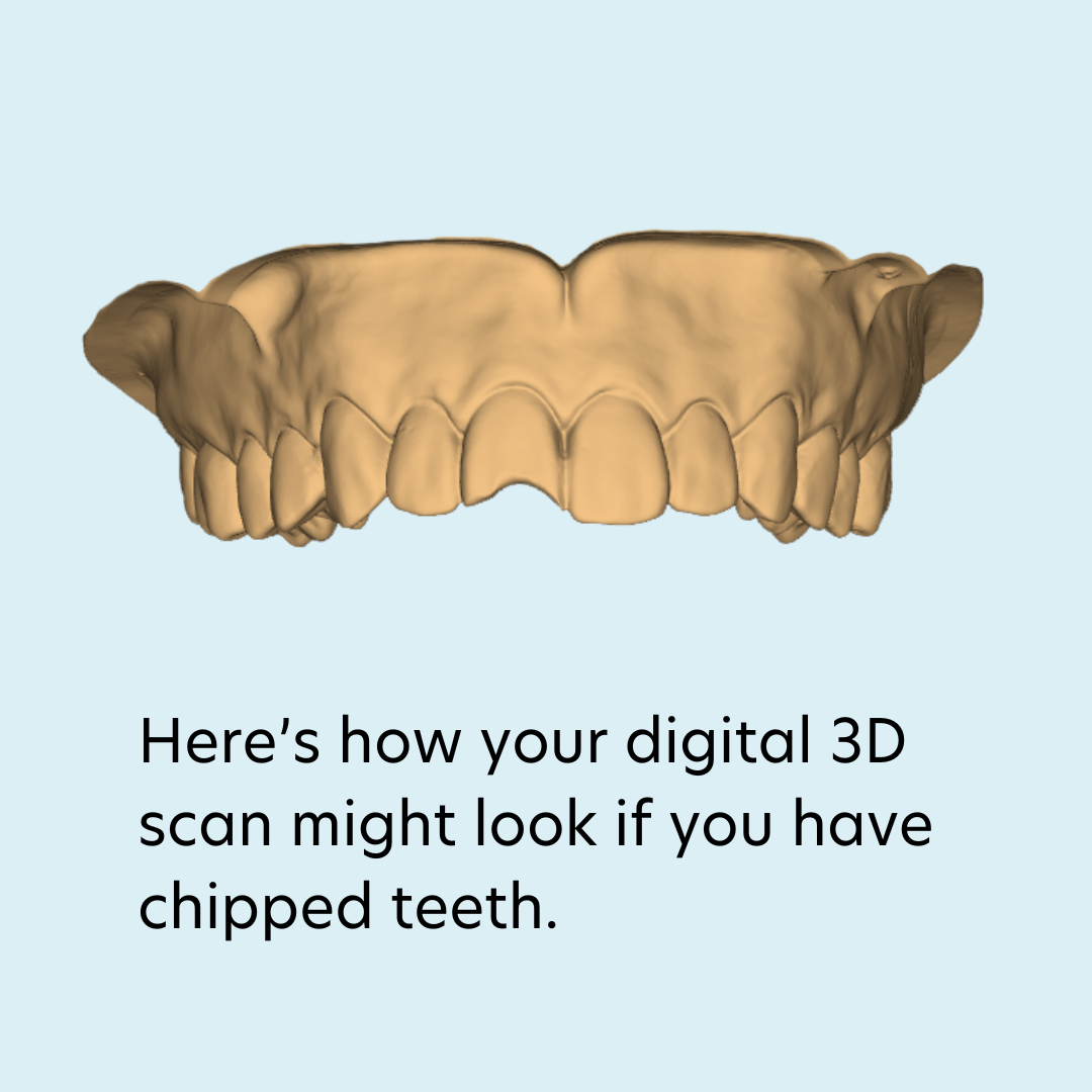 3D Scan of a person with chipped tooth