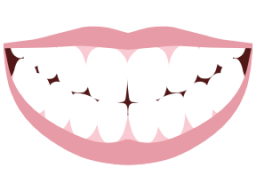 Mouth showing top and bottom veneers