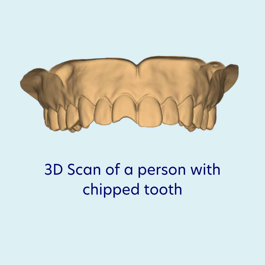 3D Scan of a person with chipped tooth