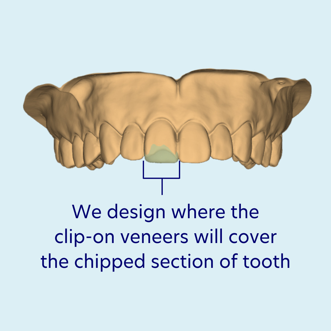 Covering chipped section of tooth example