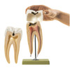 Molar Tooth with Caries Somso Es 8