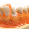 Preprepared Tooth - 3.3 Crown - LL31