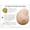 Left Breast with Irregular Masses