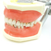 TR56C Hygiene Model with #19 edentulous and #14 super errupted