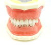 TR56C Hygiene Model with #19 edentulous and #14 super errupted