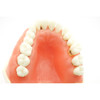 TR56C Hygiene Model with #19 edentulous and #14 super errupted