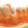 Preprepared Tooth - 3.3 Crown - LL31A