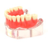 Upper denture model on 4 locator attachments