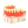 Lower denture model on 2 locator attachments