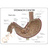 Stomach Cancer