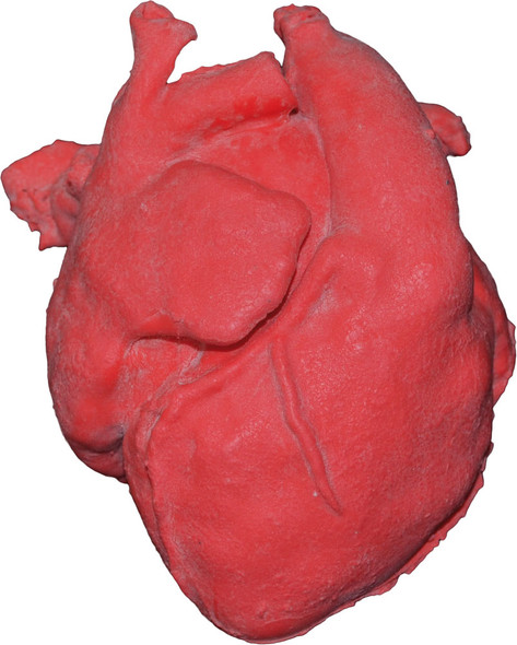 Pediatric heart with corrected transposition of great arteries and ventricular septal defect (VSD)
