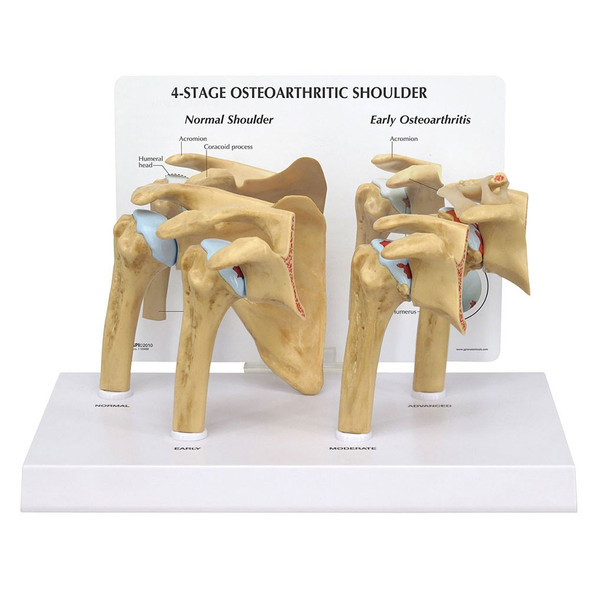 4-stage Osteoarthritis (OA) Shoulder