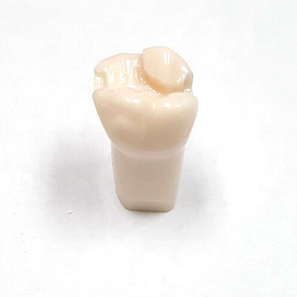 Preprepared Tooth - 2.6 (#14) MOD-B Prep - UL66L 1