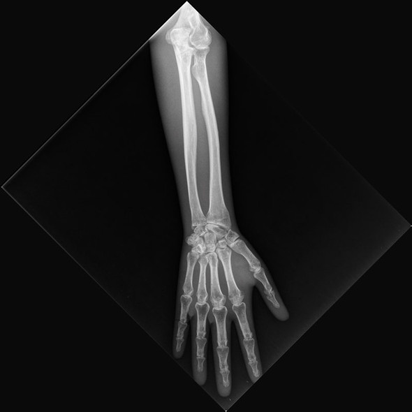 X-Ray Phantom Lower Arm, opaque