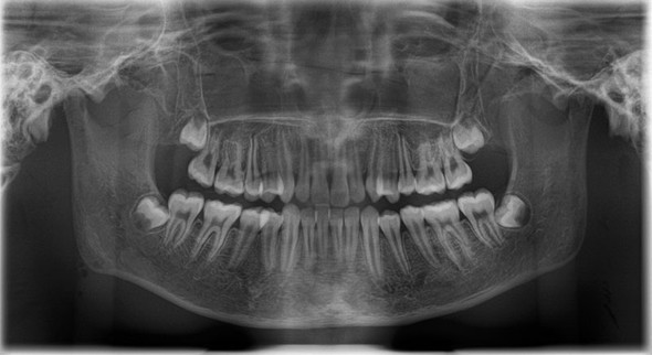 X-ray phantom head with cervical vertebrae, opaque
