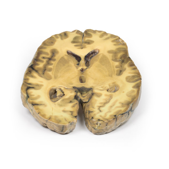 Ventriculitis, Secondary to Septicaemia