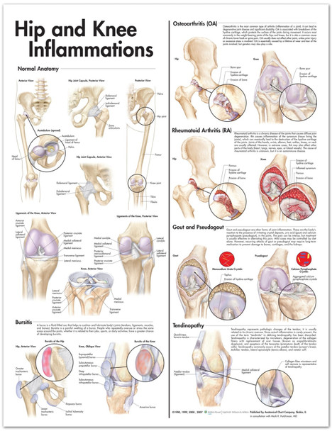 Hip Pain (Severe) - 2 X QF28-6, 1 X QF28-3