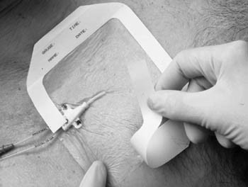 3m snap therapy system (10365058)