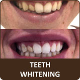 solaireicon-teethwhiteninglink.jpg