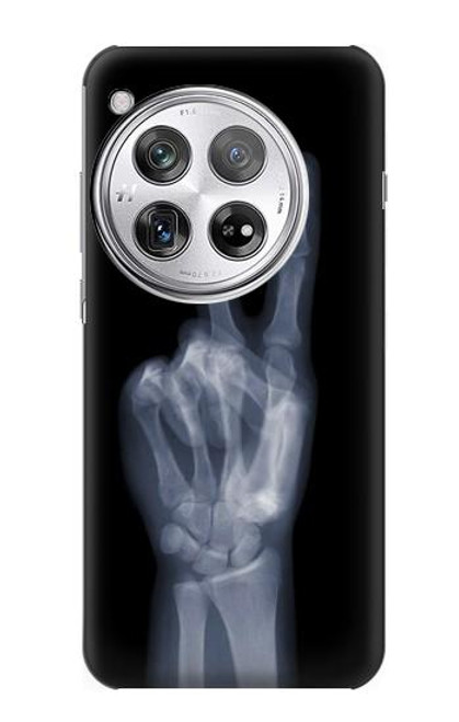 S3101 X-ray Peace Sign Fingers Hülle Schutzhülle Taschen für OnePlus 12