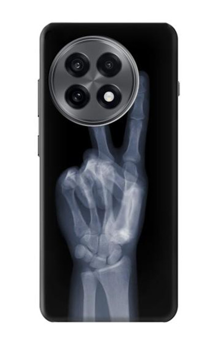 S3101 X-ray Peace Sign Fingers Hülle Schutzhülle Taschen für OnePlus 13R