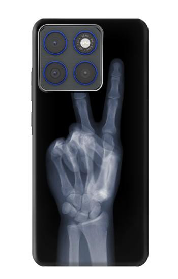 S3101 X-ray Peace Sign Fingers Hülle Schutzhülle Taschen für Motorola Edge 70