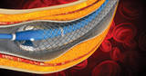 CME for Cardiologists: Dual Antiplatelet Therapy After Stent Placement