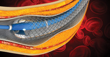 CME for Cardiologists: Dual Antiplatelet Therapy After Stent Placement