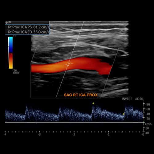 photo of monitor during a vascular ultrasound procedure