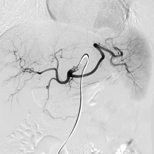 photo of interventional radiology procedure
