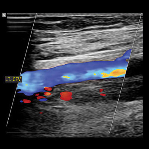 photo of vasular ultrasound monitor