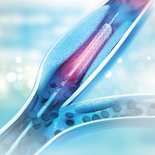 illustration of vascular stent