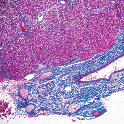 Microscope slide of stained cancer cells