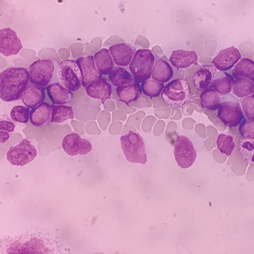 Stained microscope slide of cancer cells