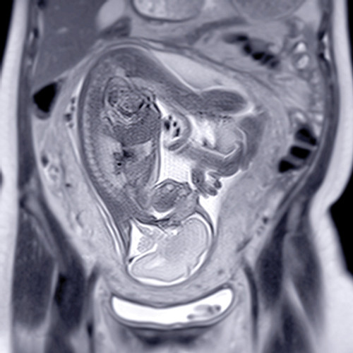 MRI image of women's reproductive organs