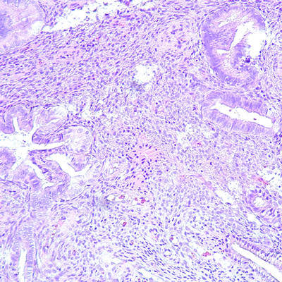 Microscopic gynecologic pathology slide