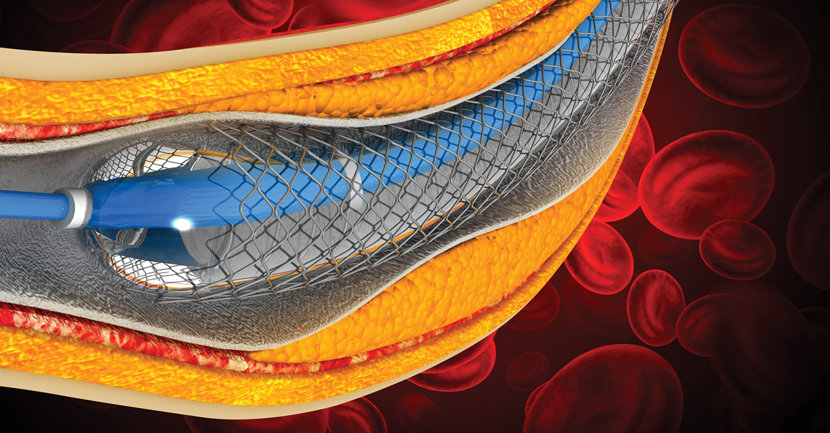CME for Cardiologists: Dual Antiplatelet Therapy After Stent Placement - Oakstone | CME