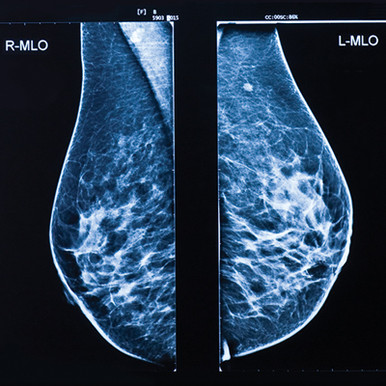 UCSF Breast Imaging