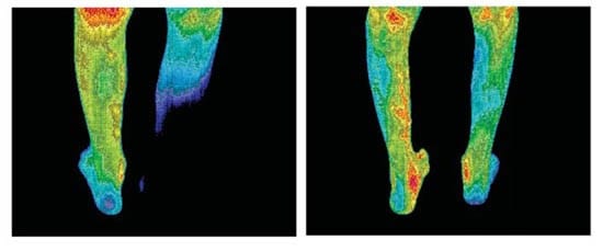 Two infrared photos of a pair of legs.  One is before treatment with a BIomat showing poor circulation.  The other photo is a pair of legs with good circulation after using Biomat.