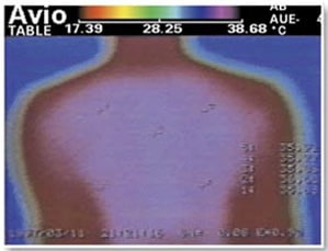 Infrared image of a person's back after using Biomat with a lot of internal heat.