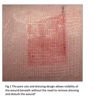 Applying Adaptic non-adhering dressing to wound – prevents dressing adherence and minimizes pain during removal