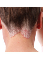 Close-up of TriDerma psoriasis scalp shampoo ingredients – 3% salicylic acid for exfoliating buildup
