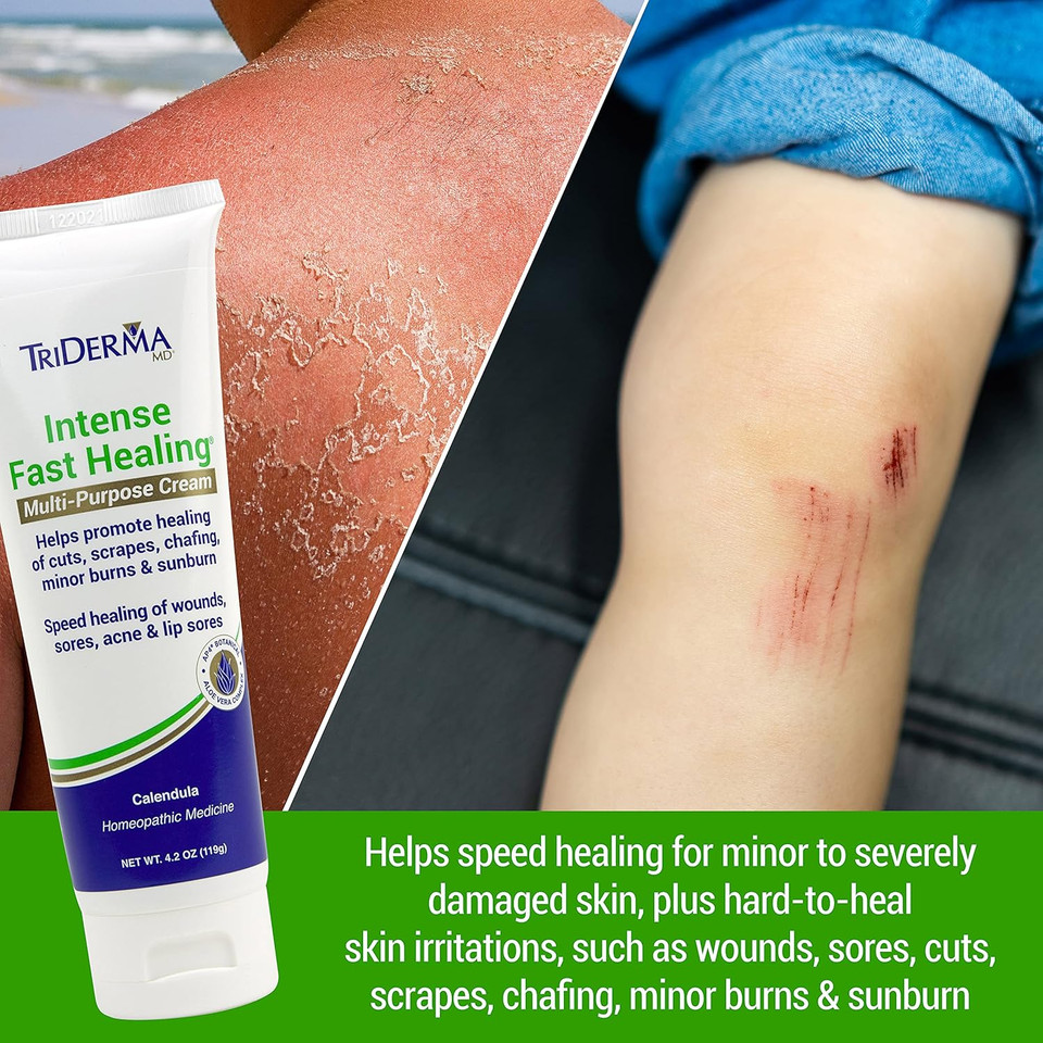 TriDerma intense cream being applied to minor burn – fast-acting relief for hard-to-heal skin irritations