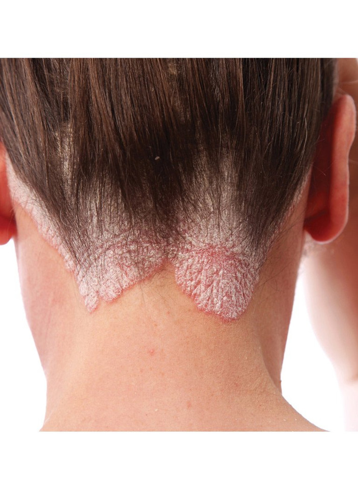Close-up of TriDerma psoriasis scalp shampoo ingredients – 3% salicylic acid for exfoliating buildup