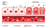 Leaky Gut Basics 2013