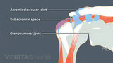 Subacromial Impengement Syndrome