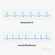 Atrial Fibrillation