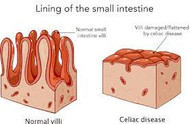 Celiac Disease: Your Questions Answered