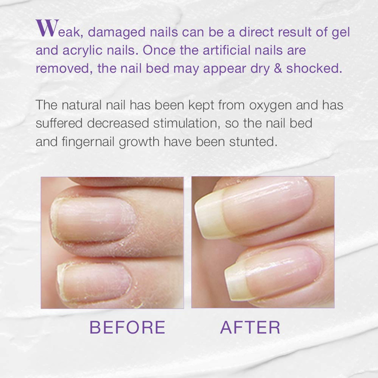 Badly Damaged Nails | Gel Polish Allergy, Nail Plate Burn, Onycholysis -  YouTube